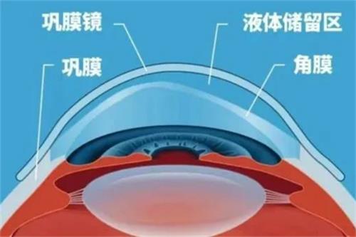 内行人说实话:巩膜镜适用范围,作用是什么,对眼睛有伤害吗?