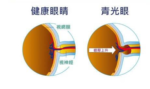 正产眼对比青光眼展示图