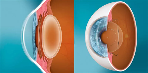 人工晶体植入正面和侧面对比 人工晶体植入正面和侧面对比