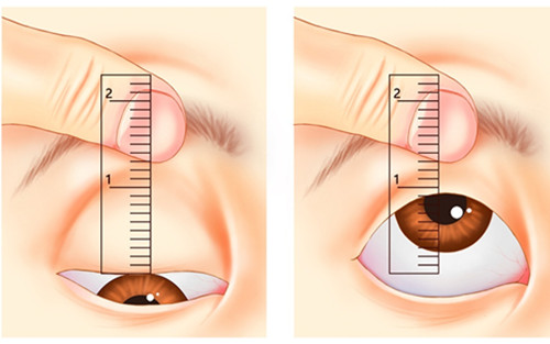 眼睑是否下垂自测图
