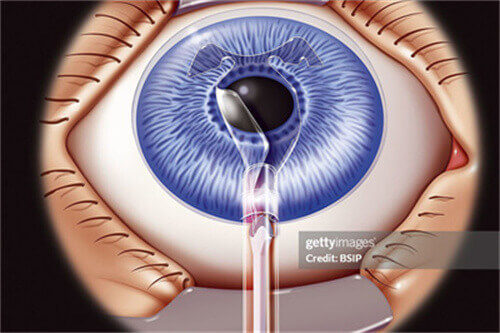 icl晶体植入手术
