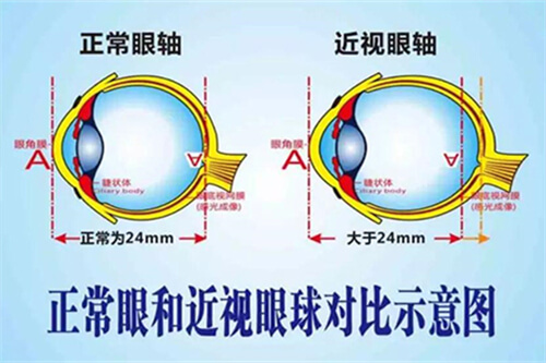 高度近视角膜变形是不正常现象吗?超过600度近视需加以这些措施!