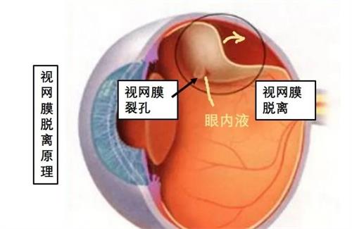 视网膜脱落原理