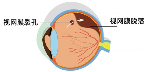 视网膜脱落后眼睛会变成怎样?不光视力下降,视野也受限!