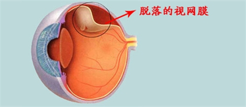 脱落的视网膜