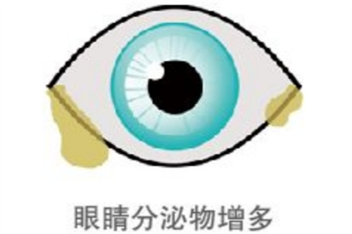 眼睛分泌物增多示意图