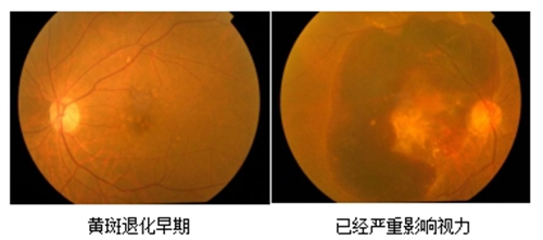 一只眼黄斑水肿,另一只眼会病变吗?需重视!仍可能有患病风险