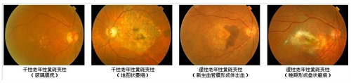 黄斑病变不同的表现