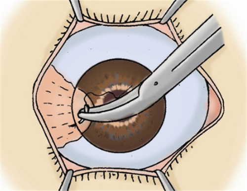 角膜移植手术缝合过程图解