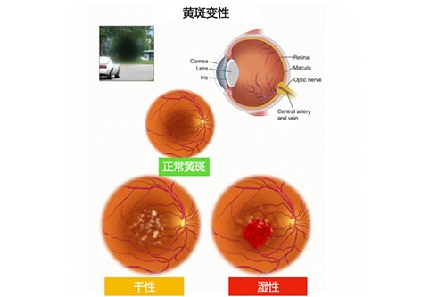 黄斑变性类别图片