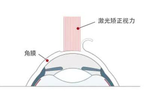 激光近视矫正改善