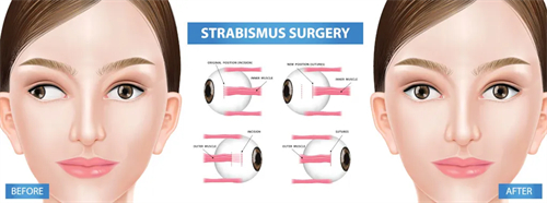 斜视手术原理图