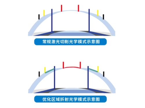 金视·青春之光和普通飞秒手术区别