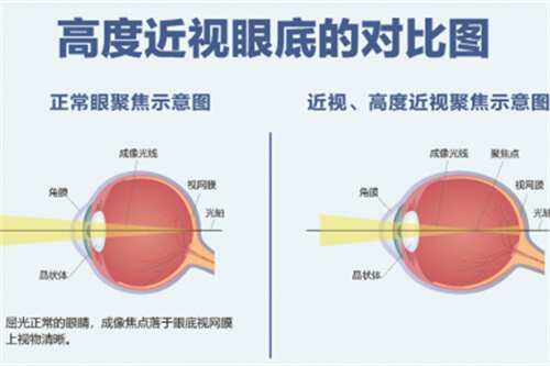 高度近视眼底的对比图