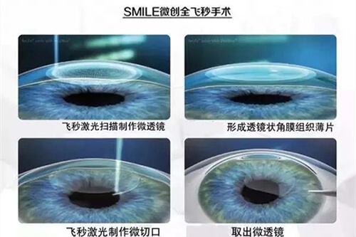 微创全飞秒手术过程示意图