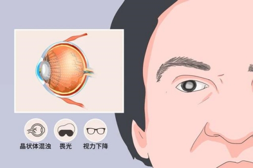 [2025普瑞眼科医院白内障手术费用表]一文揭晓普瑞眼科医院白内障手术 人工晶体手术多少钱!