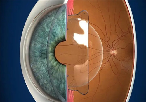 晶体植入近视手术模拟图