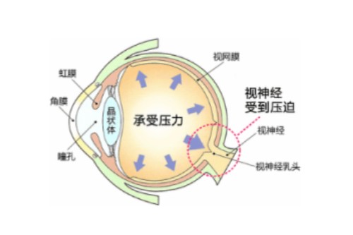 眼睛眼压高概念图