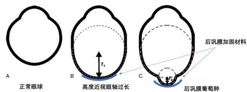 巩膜收缩术会视野缺损吗?看下真实的手术原理，顾客反馈与风险!