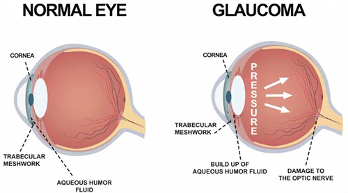 青光眼和正常眼睛对比