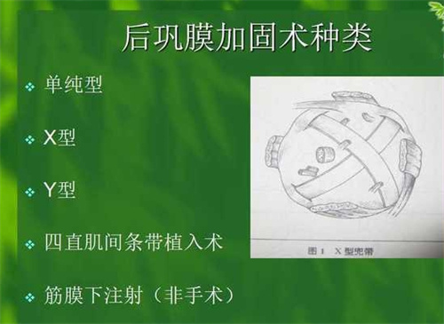 王乐今后巩膜加固术费用在3.6万元起,单眼价格1.8万元起,预约王乐今去北京熙仁医院挂号更快!