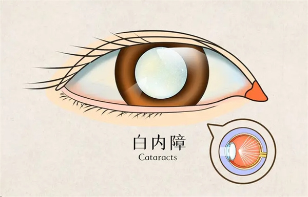 白内障做手术免费有这个政策吗?现在还有免费做白内障手术的吗?2025年白内障免费治疗政策公布!